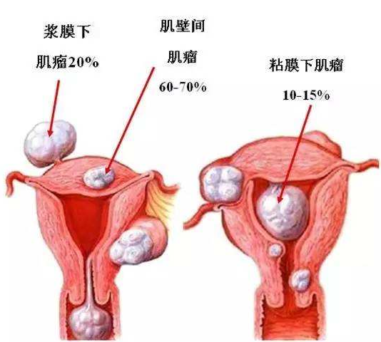 超声引导下射频消融子宫肌瘤,腺肌病(腺肌瘤)