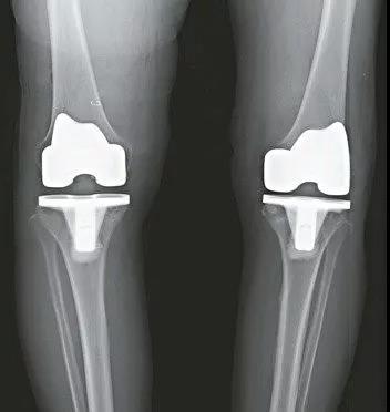台湾双侧人工膝关节置换手术