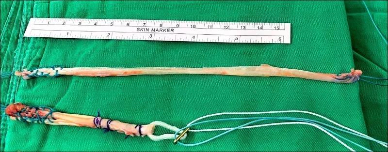 前十字韧带重建合并外侧肌腱固定特殊编织方法