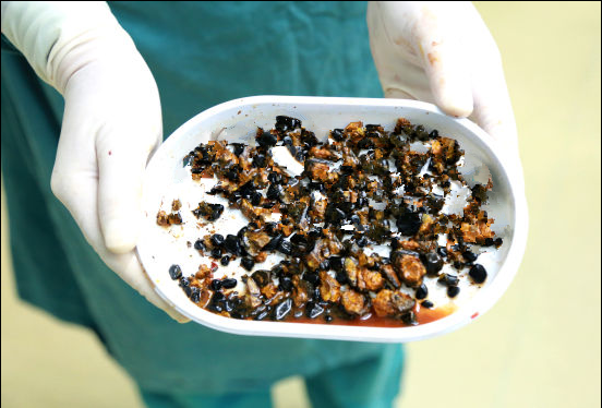 我院胆石症案例,主要危害及治疗