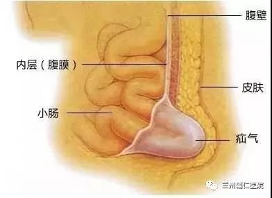 疝气睾丸症状图片