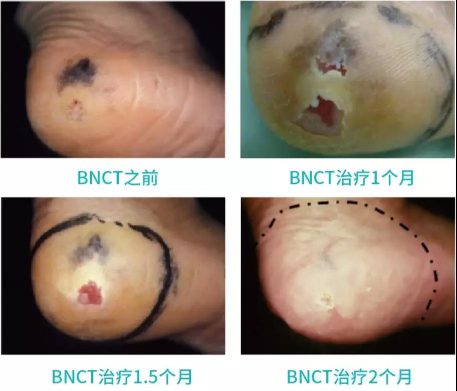 硼中子俘获治疗技术