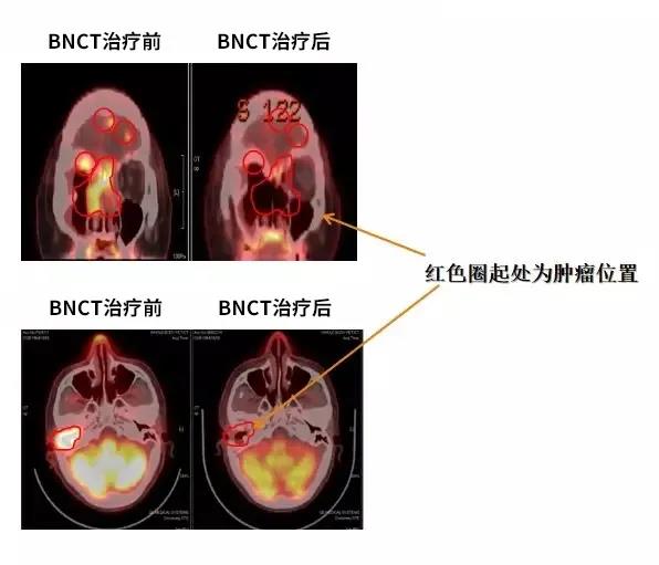 硼中子俘获治疗技术BNCT适应症