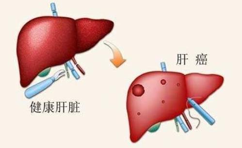 台湾长庚医院质子治肝癌