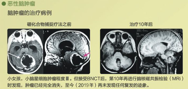 BNCT案例 | 头颈部肿瘤&恶性脑肿瘤治疗案例