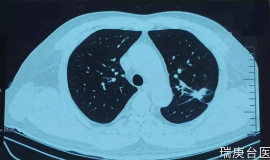 肺癌案例 | 質子治療優于手術可治愈