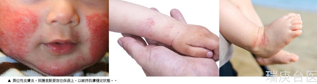 新手爸媽須知 | 別把「異位性皮膚炎」當成「脂漏性皮膚炎」，錯失寶貝黃金治療期