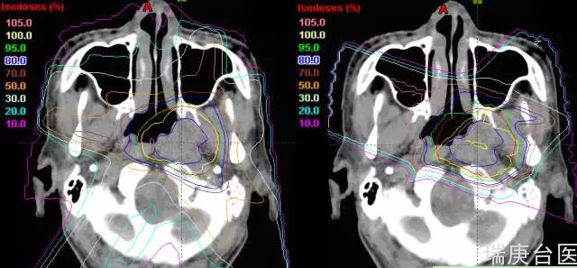 复发鼻咽癌 | 质子治疗有明显优势