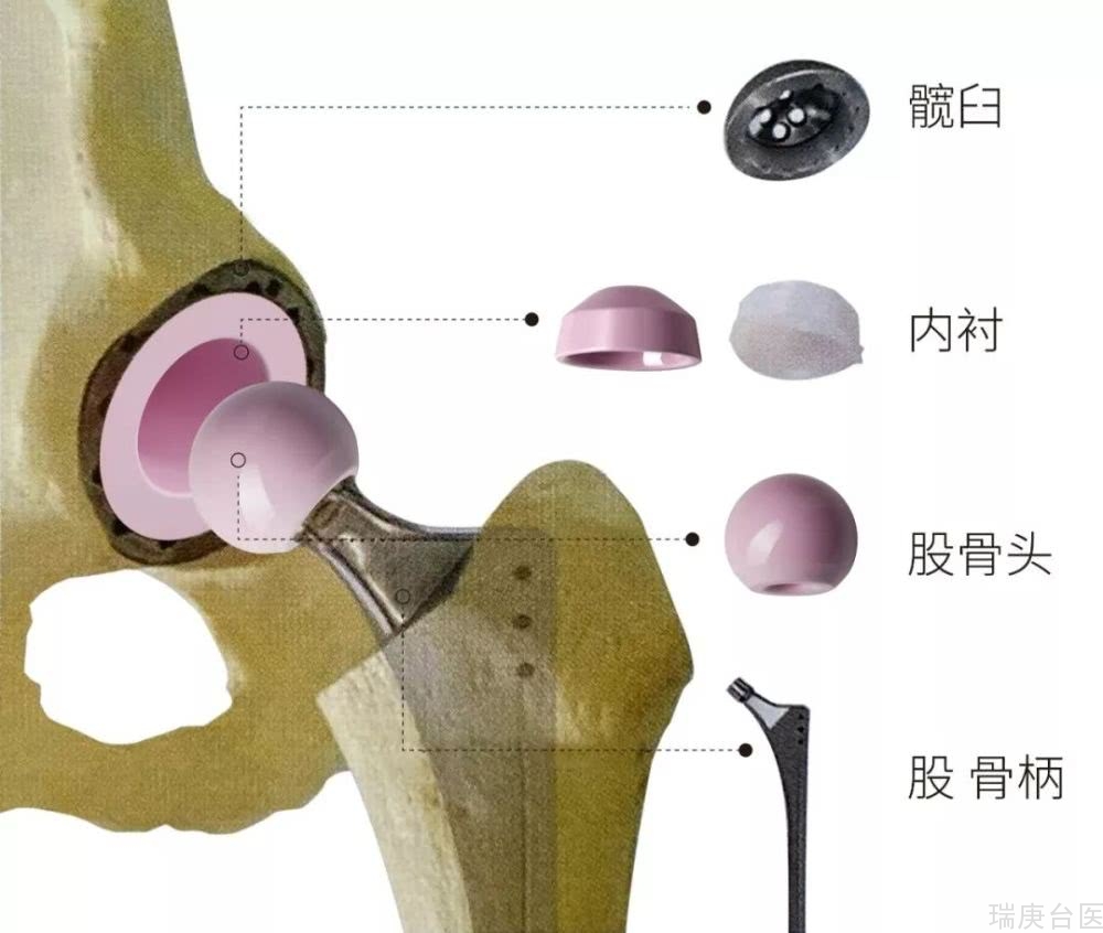 人工关节置换