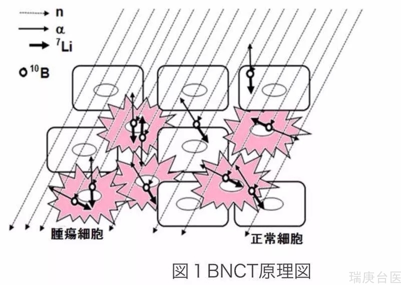 BNCT | 癌症治疗再添新利器！硼中子捕获治疗可望引进台湾，杀癌细胞更<span style=