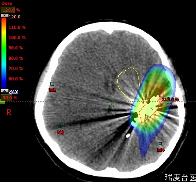 质子治疗 | 质子立体定位放射手术于脑动静脉血管畸形之应用