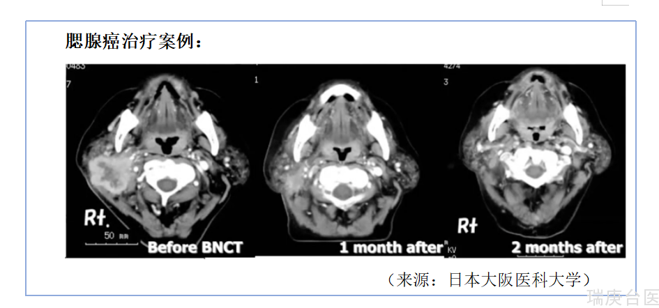 BNCT | 头颈部腮腺癌案例分享