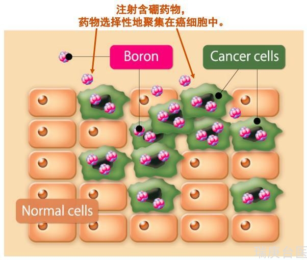 BNCT | 头颈部腮腺癌案例分享