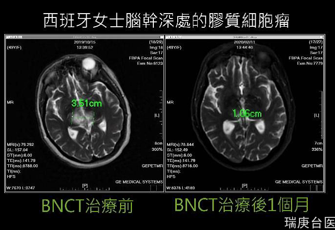 BNCT案例 | 台湾硼中子捕获治疗标靶辐射治癌