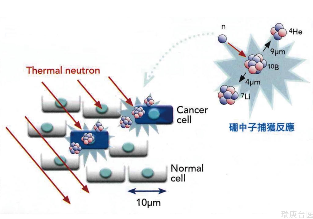 BNCT | 需广泛被认知的癌症另类疗法 