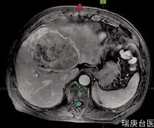 质子治疗 | 肝癌患者治疗2月肿瘤缩小明显