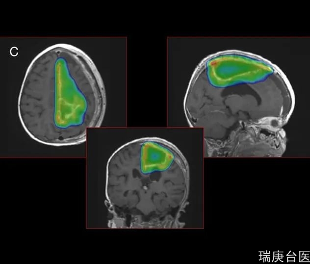 质子治疗脑膜瘤 | 肿瘤持续缩小，3年多无复发，无副作用，认知发育正常