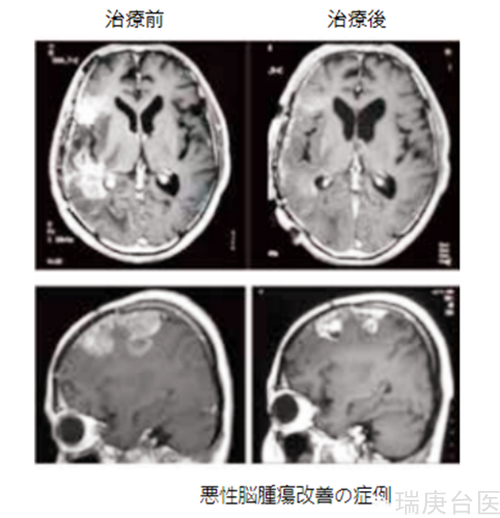 BNCT | 恶性脑肿瘤治疗案例