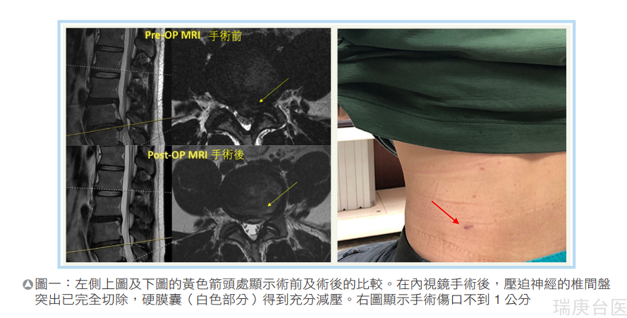 微创脊椎内视镜手术　小伤口解决骨刺及神经压迫造成的神经痛