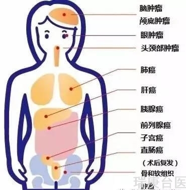 案例分享 | 血管周细胞瘤复发，质子治疗肿瘤较治疗前明显缩小